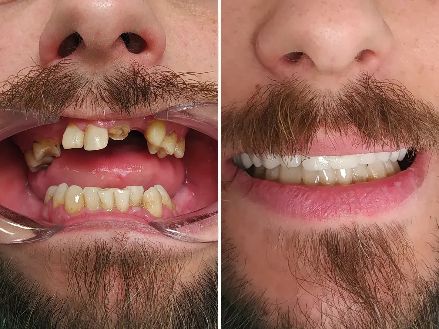 Caso real: rehabilitación completa de la arcada superior antes y después en Clínica Dental Doctor Uson