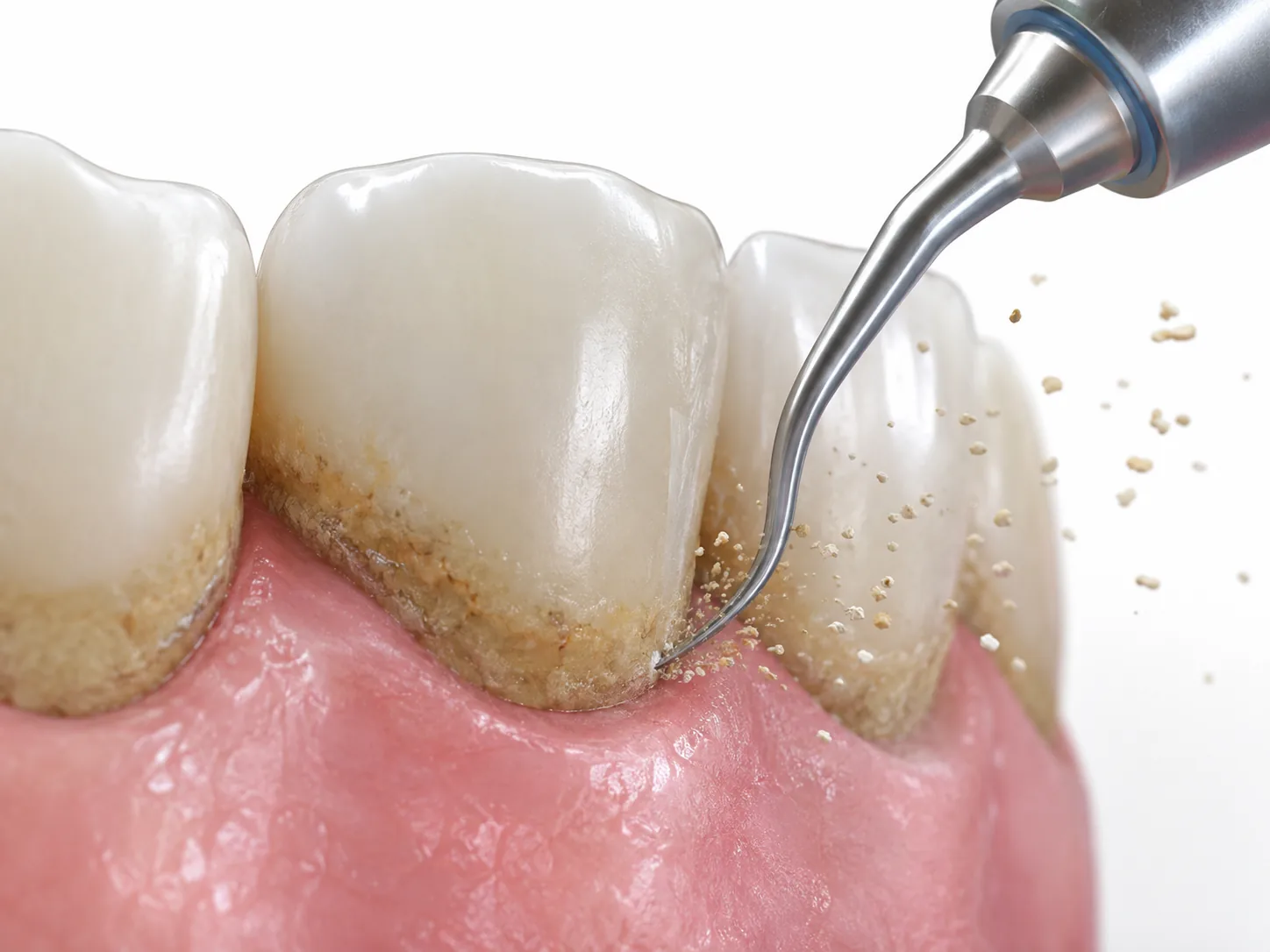 Eliminación de sarro con ultrasonidos en la línea de la encía — render 3D pedagógico