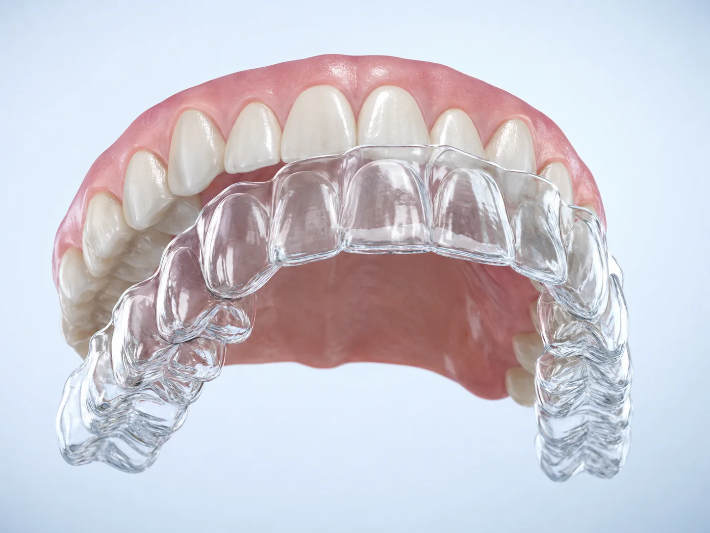 Alineador transparente de ortodoncia invisible colocándose sobre los dientes — render 3D