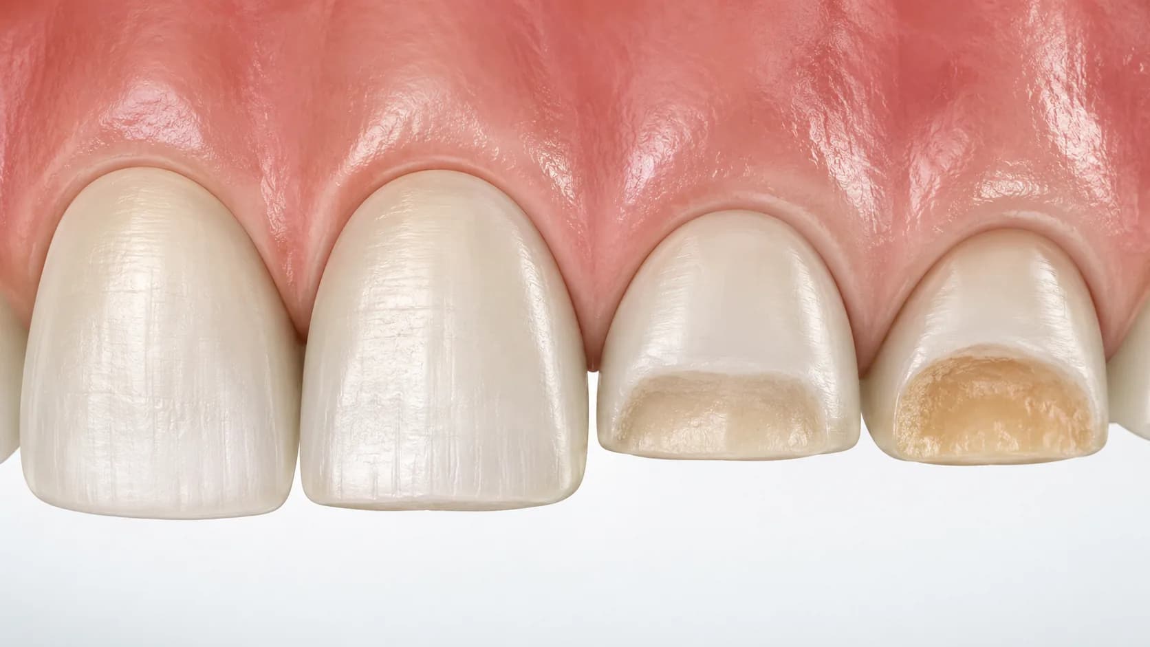 Grados de desgaste dental por bruxismo: sano, leve, moderado y severo — ilustración 3D