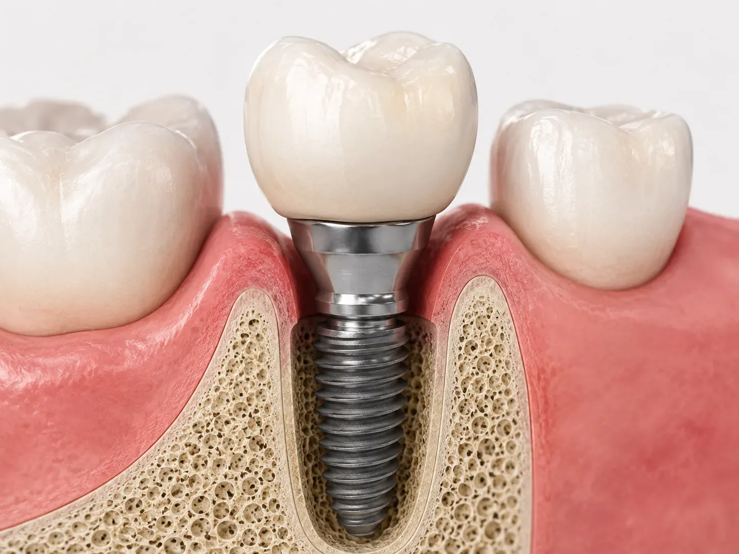 Implante dental de titanio integrado en el hueso maxilar — corte anatómico 3D
