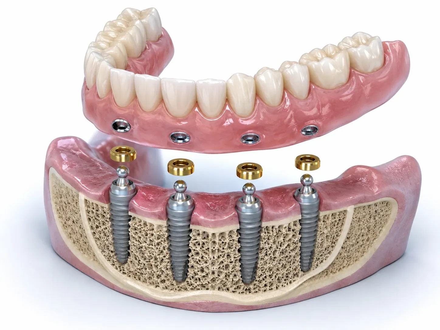 Sobredentadura sobre cuatro implantes con anclajes snap-on — corte 3D pedagógico